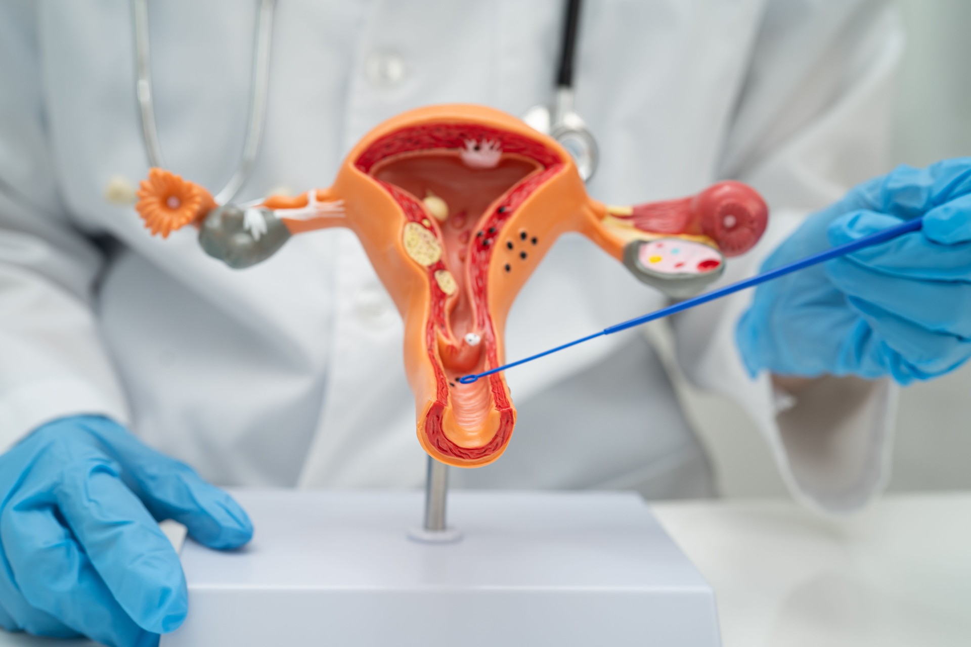 Doctor holding human uterus model for vaginal and cervix pap smear check up in the obstetrics and gynecology.